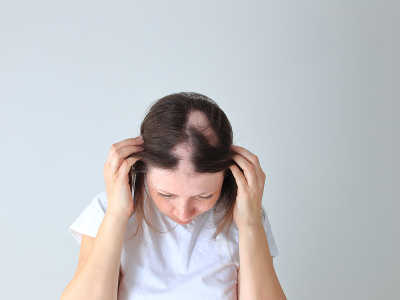 Vrouw met alopecia vraagt zich af, 