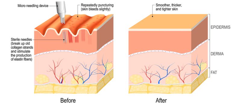 Microneedling voor haaruitval grafisch