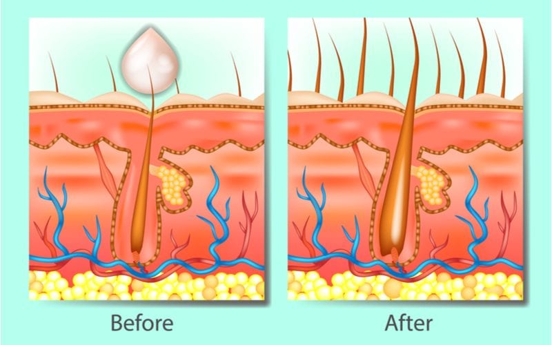 Haargroei shampoo voor en nadelen met een voor en na gebruik van het product in een uitsnede van de hoofdhuid en haarzakjes