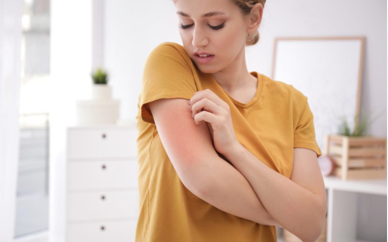 Vrouw met uitslag die een allergische reactie heeft op kokosolie in een oranje shirt voor een stuk over het testen op reacties bij het leren hoe je kauwgom uit het haar krijgt.