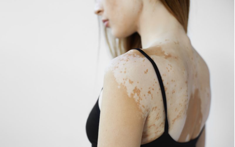 Gal met Vitiligo aandoening draagt een zwart spaghettiband hemdje