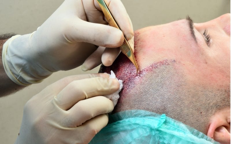 Man krijgt een haartransplantatie van een arts en kijkt recht op een stuk over haartransplantatie kosten