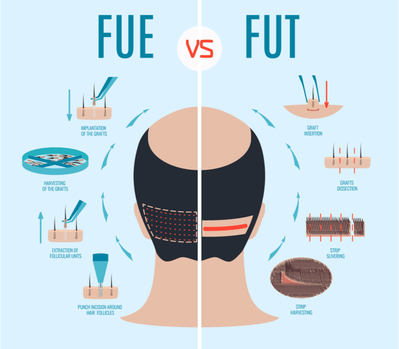 Fue vs Fut haartransplantatie kosten grafiek