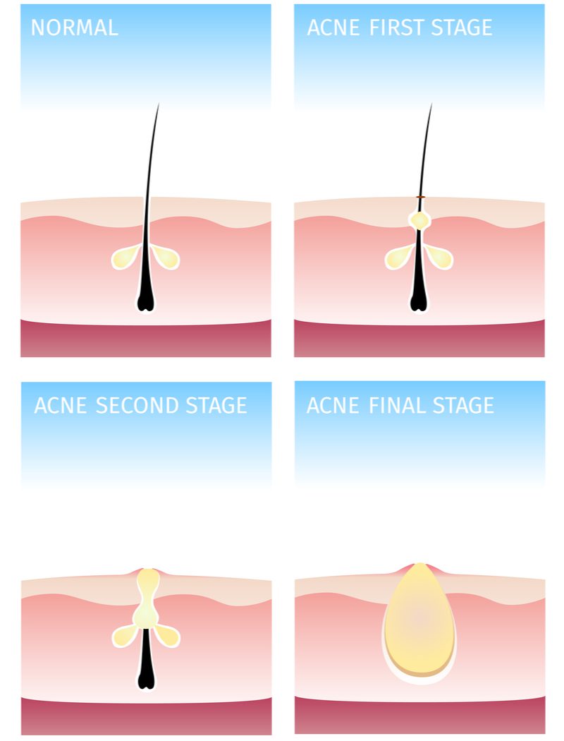 Afbeelding die laat zien hoe acne ontstaat voor een stuk over hoe je haar te verhelderen