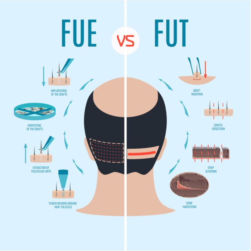 Fue vs Fut transplantatie voor een stuk getiteld Should I Get a Hair Transplant