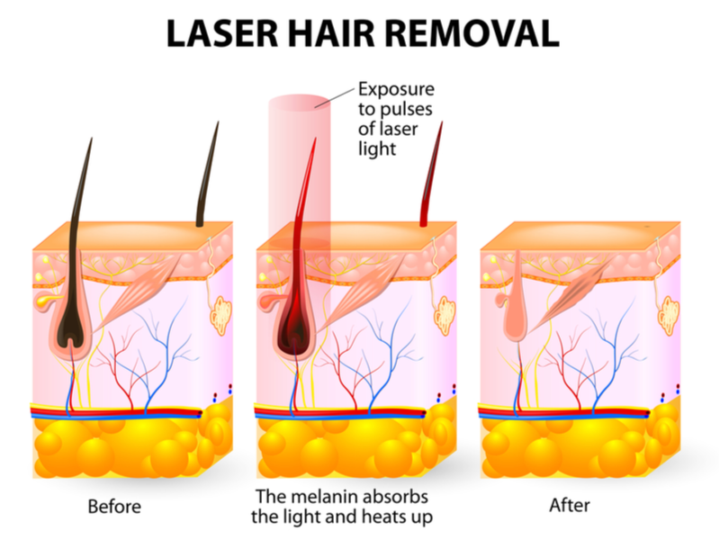 Hoe laser ontharing werkt voor een stuk over moet je laser ontharing krijgen