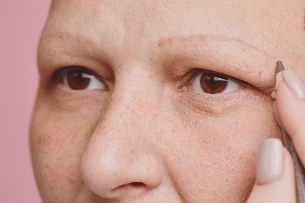 Vrouw met alopecia (haaruitval) op haar wenkbrauwen voor een stukje over groeien wenkbrauwen terug