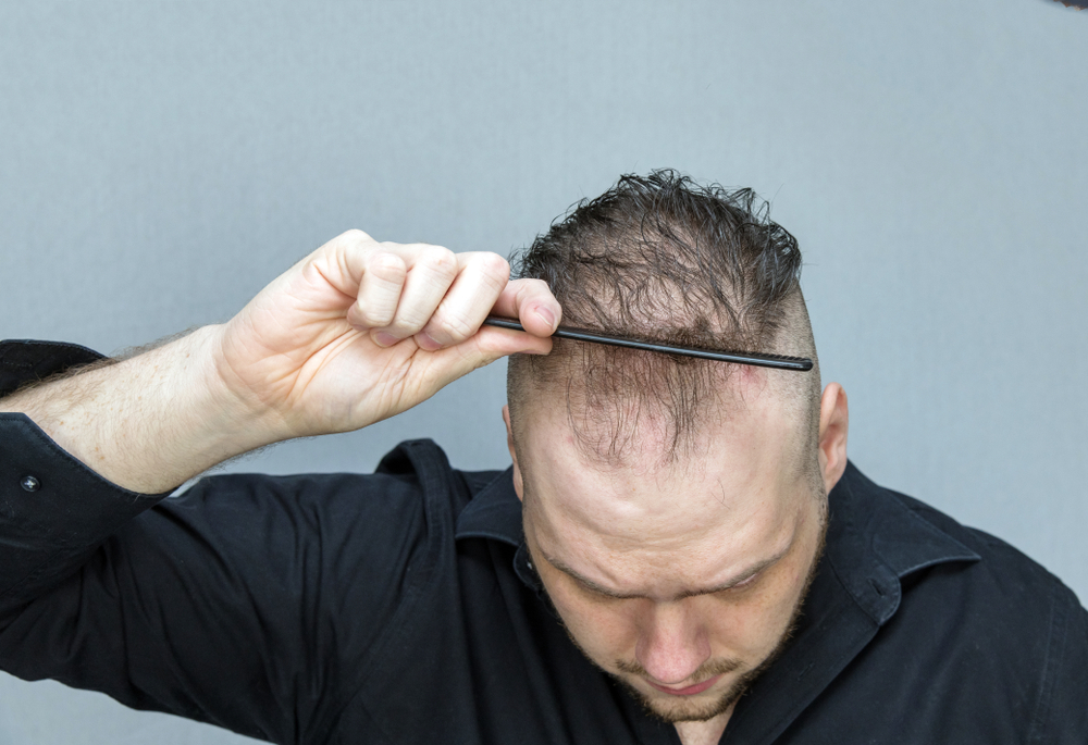 Man met dun haar trekt zijn haar terug met een kam