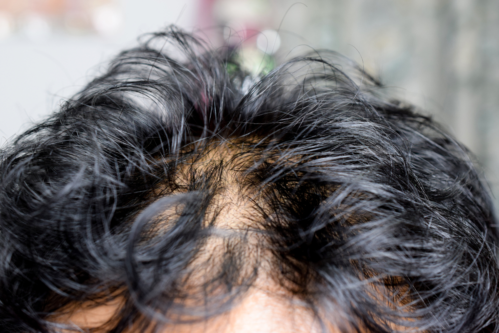 Man met vet haar en een droge hoofdhuid in een close-up foto