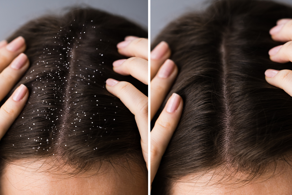 Voor en na foto die laat zien hoe de hoofdhuid eruit ziet na gebruik van glycolzuur voor roos en schilfers op donker haar