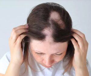 Alopecia Areata Haaruitval