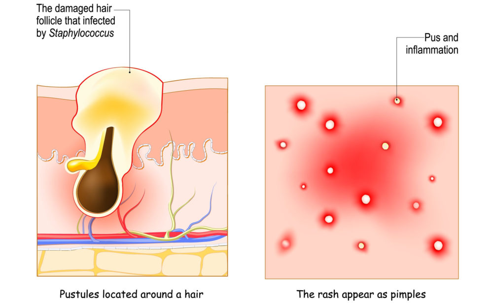 The 7 Best Shampoos for Folliculitis in 2022