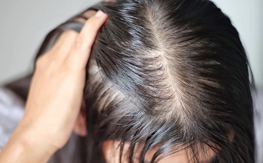 Wat is hormonale haaruitval en hoe onbalans haarproblemen veroorzaakt?